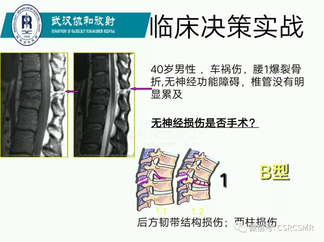 影像PPT - 【PPT】急性脊髓损伤--MR在临床决策和预后中的应用-54