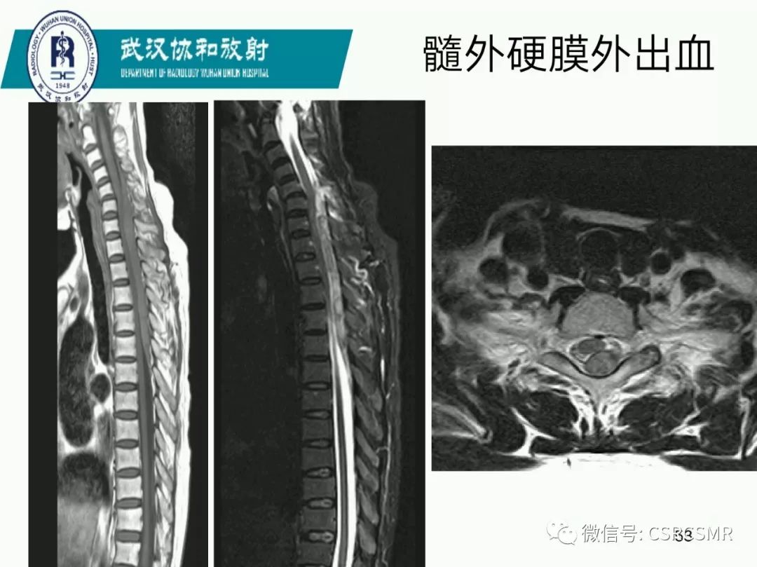 影像PPT - 【PPT】急性脊髓损伤--MR在临床决策和预后中的应用-53