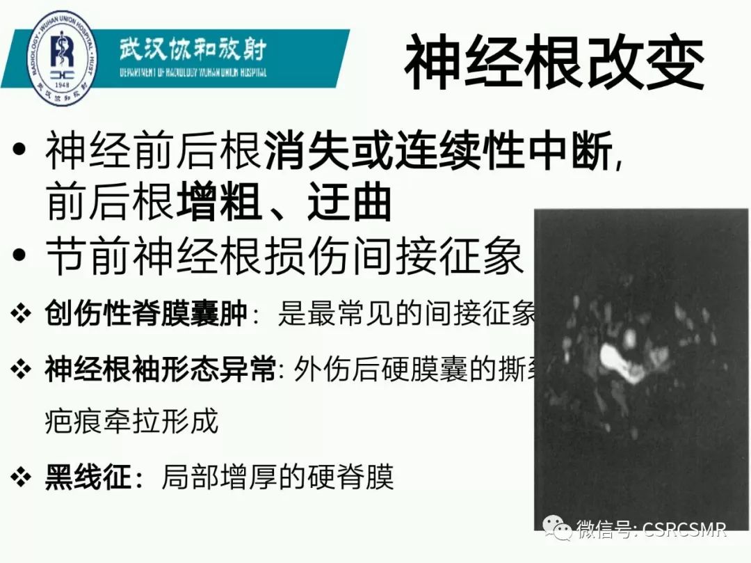 影像PPT - 【PPT】急性脊髓损伤--MR在临床决策和预后中的应用-52