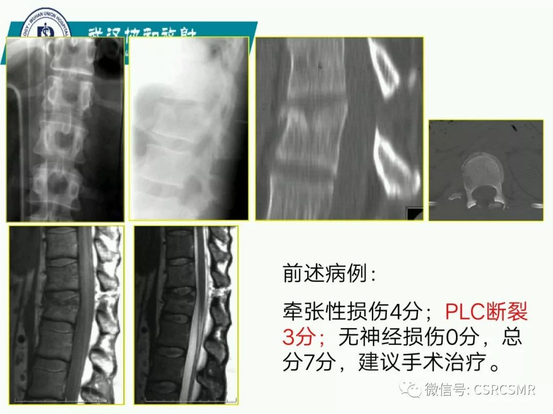 影像PPT - 【PPT】急性脊髓损伤--MR在临床决策和预后中的应用-56