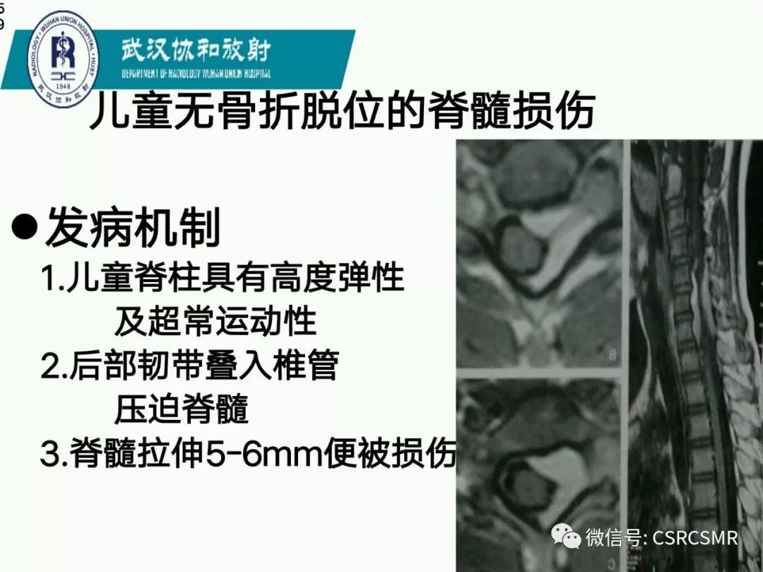 影像PPT - 【PPT】急性脊髓损伤--MR在临床决策和预后中的应用-59
