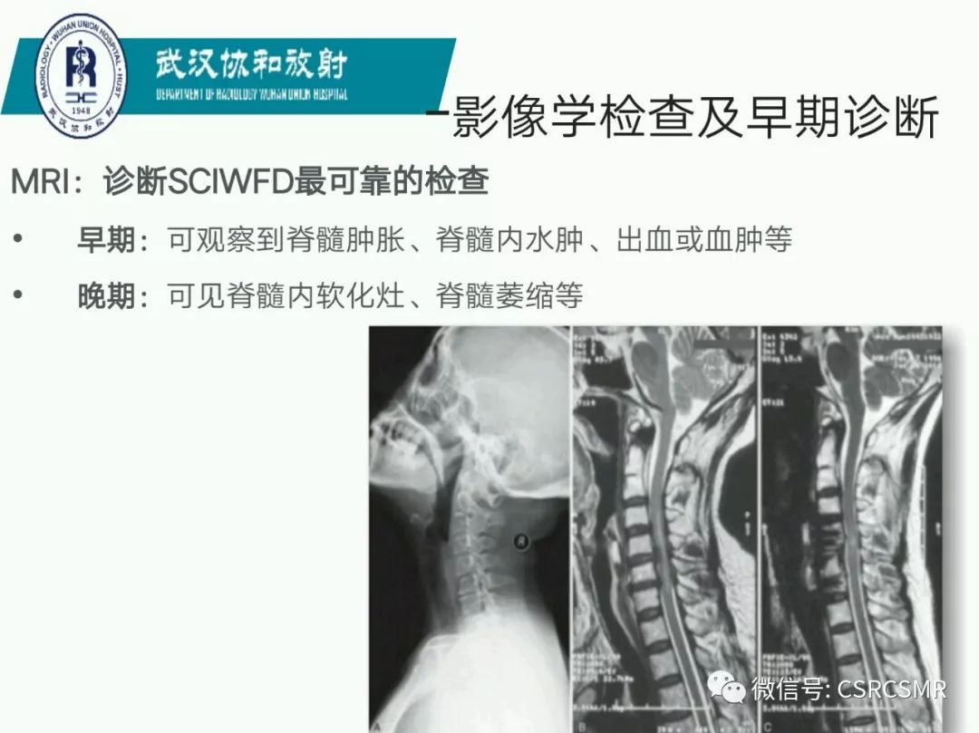 影像PPT - 【PPT】急性脊髓损伤--MR在临床决策和预后中的应用-60