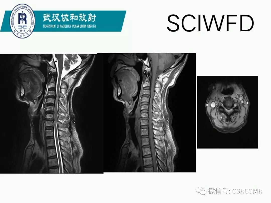 影像PPT - 【PPT】急性脊髓损伤--MR在临床决策和预后中的应用-61