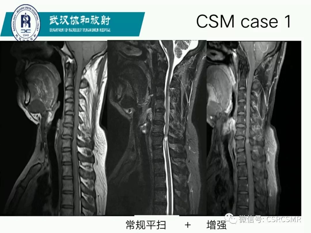 影像PPT - 【PPT】急性脊髓损伤--MR在临床决策和预后中的应用-63