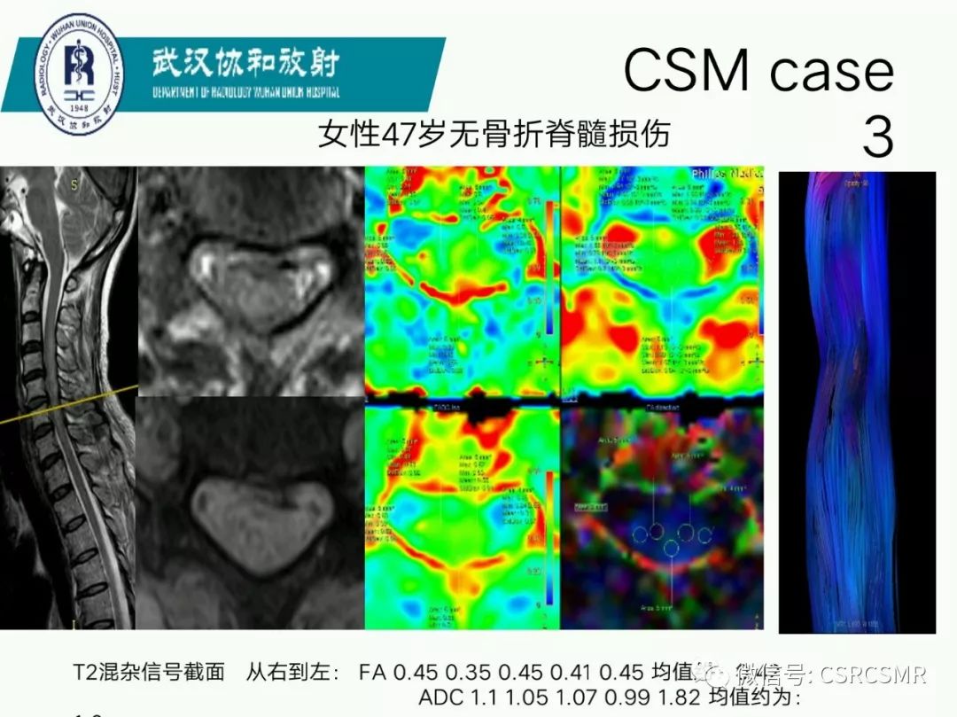 影像PPT - 【PPT】急性脊髓损伤--MR在临床决策和预后中的应用-65