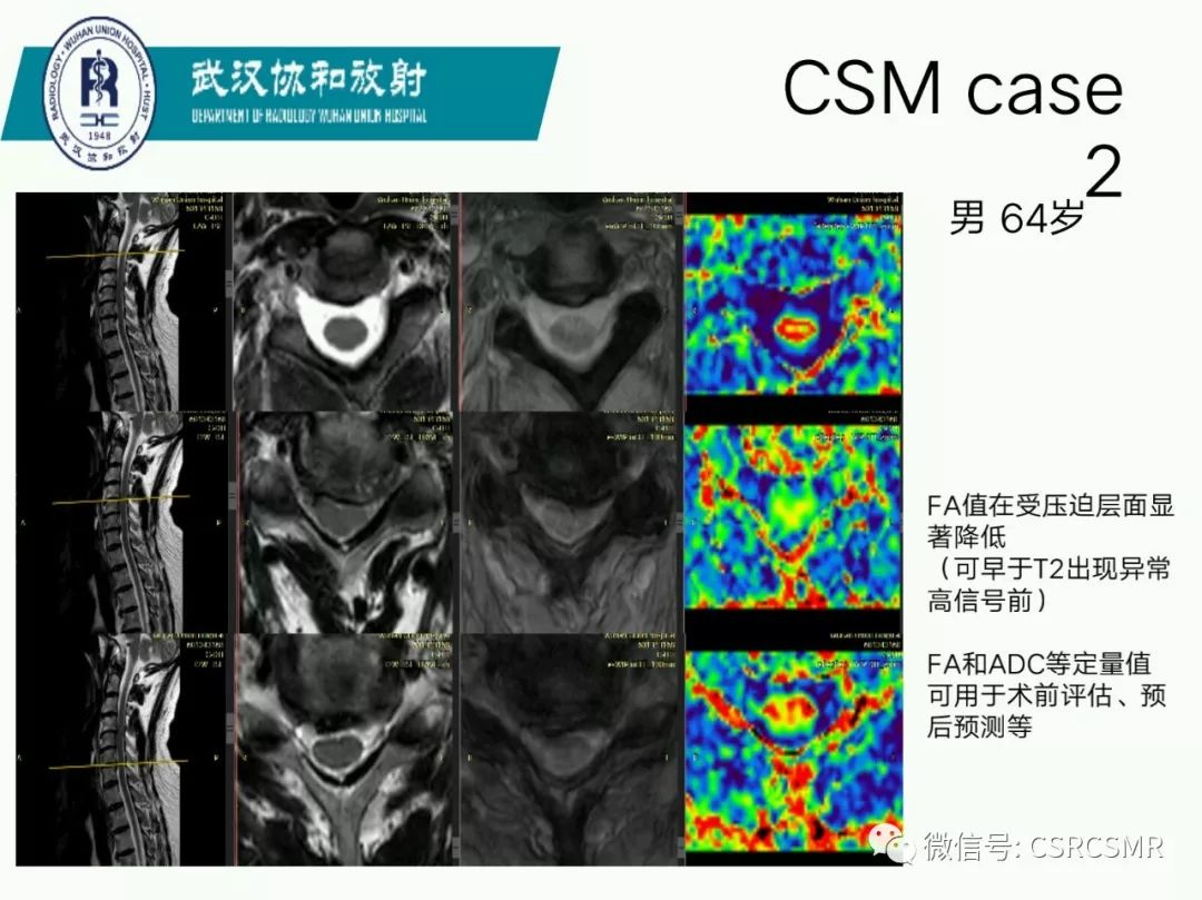 影像PPT - 【PPT】急性脊髓损伤--MR在临床决策和预后中的应用-64