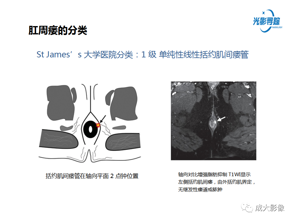 影像PPT - 【PPT】磁共振成像评估—肛周瘘的诊断：影像学特征谱-17