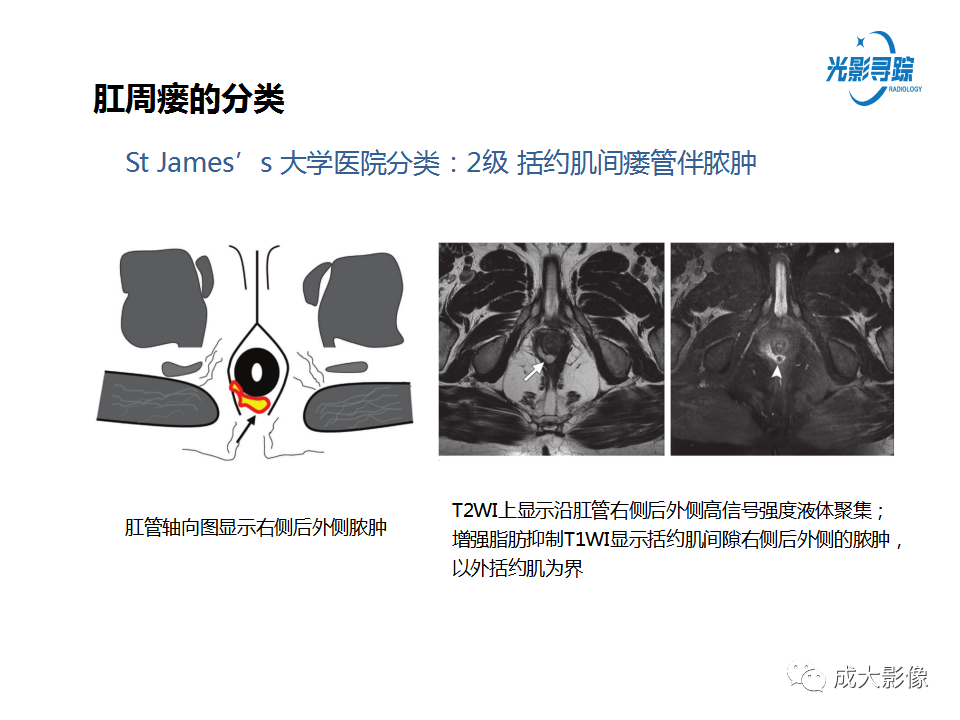 影像PPT - 【PPT】磁共振成像评估—肛周瘘的诊断：影像学特征谱-18