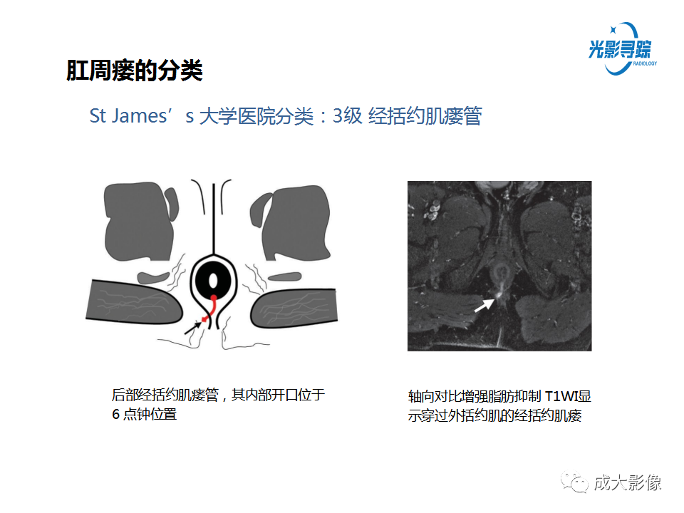 影像PPT - 【PPT】磁共振成像评估—肛周瘘的诊断：影像学特征谱-19