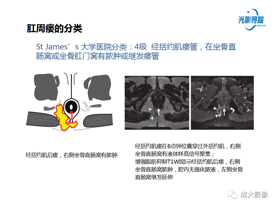 影像PPT - 【PPT】磁共振成像评估—肛周瘘的诊断：影像学特征谱-20