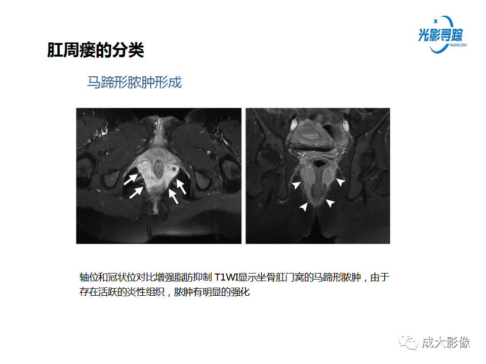 影像PPT - 【PPT】磁共振成像评估—肛周瘘的诊断：影像学特征谱-21