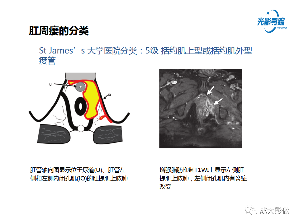 影像PPT - 【PPT】磁共振成像评估—肛周瘘的诊断：影像学特征谱-22