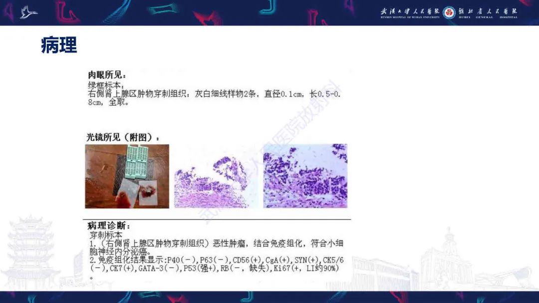 影像PPT - 【PPT】肾上腺肿瘤影像诊断-5
