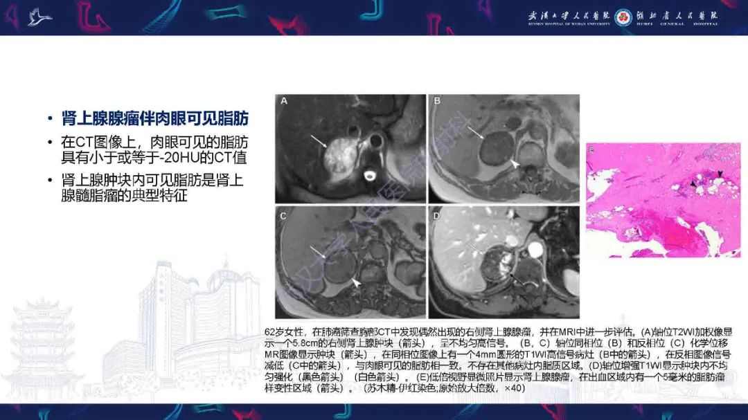 影像PPT - 【PPT】肾上腺肿瘤影像诊断-12