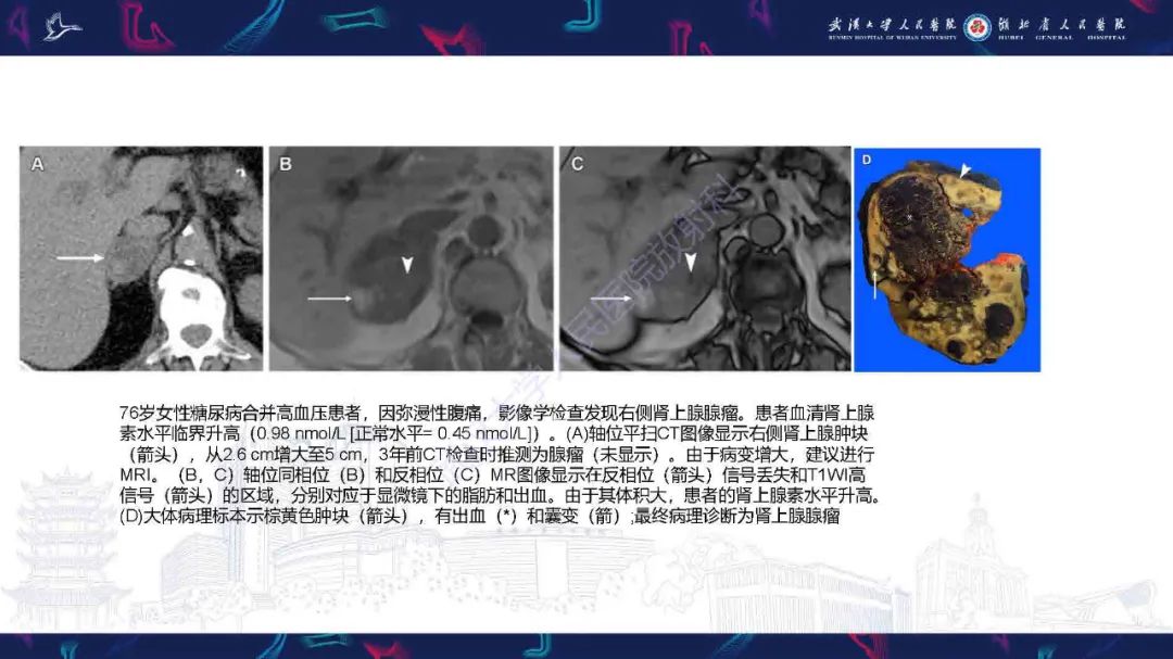影像PPT - 【PPT】肾上腺肿瘤影像诊断-14