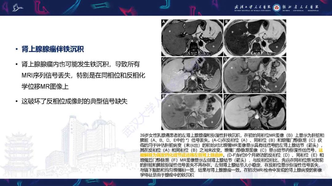 影像PPT - 【PPT】肾上腺肿瘤影像诊断-15