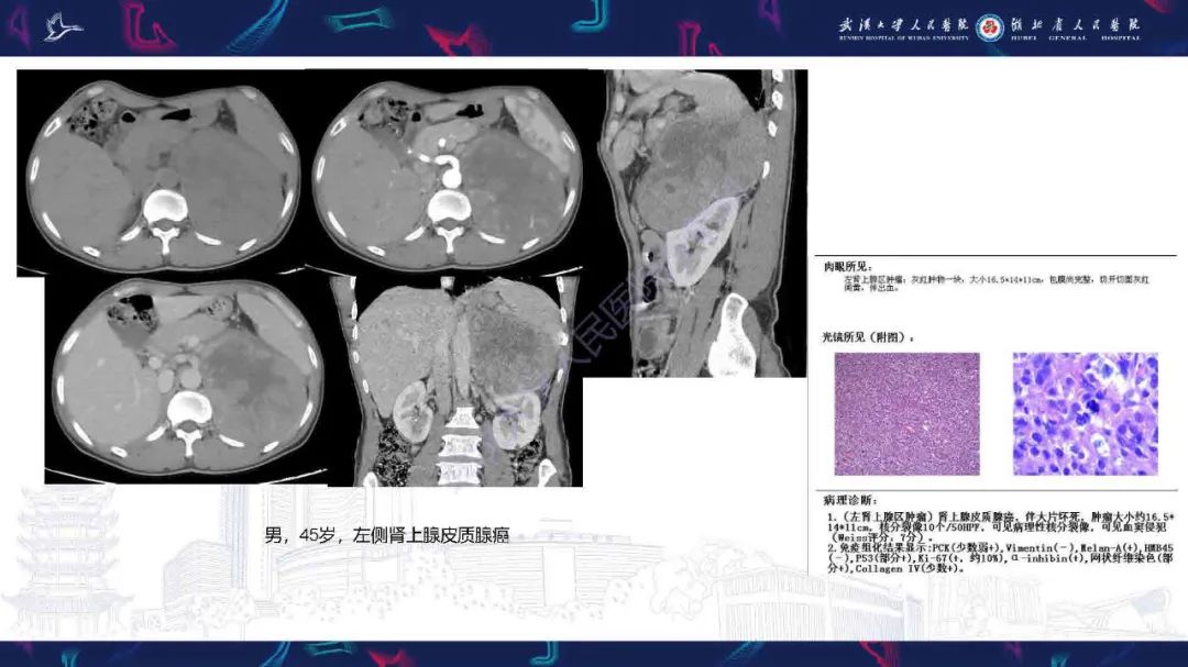 影像PPT - 【PPT】肾上腺肿瘤影像诊断-19