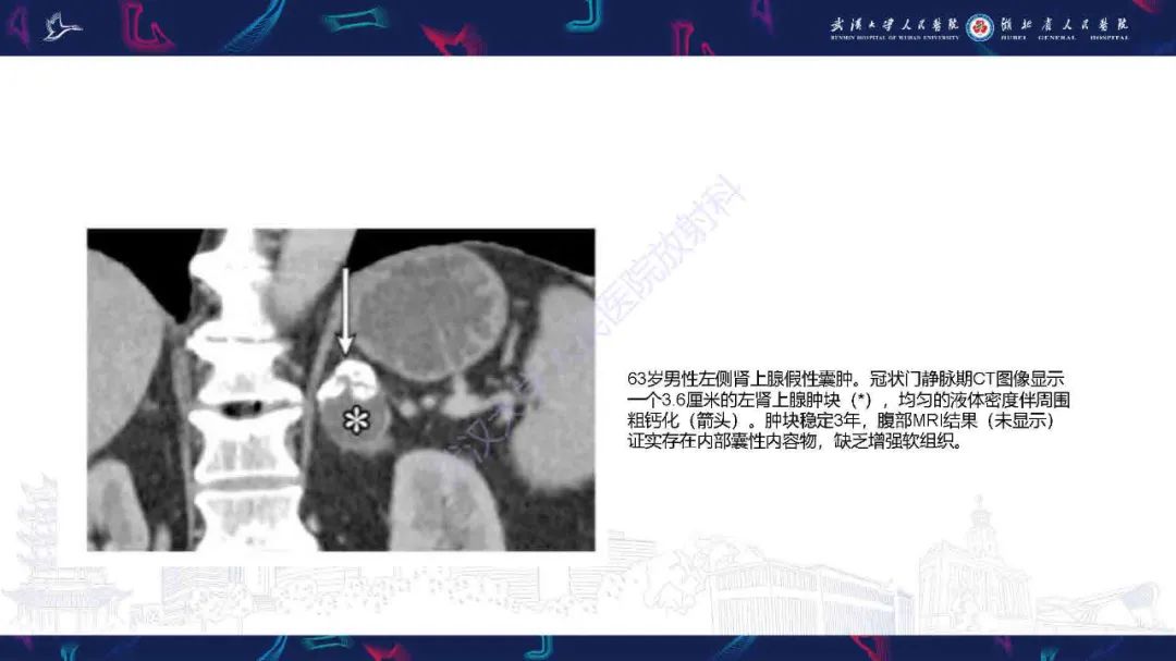 影像PPT - 【PPT】肾上腺肿瘤影像诊断-21