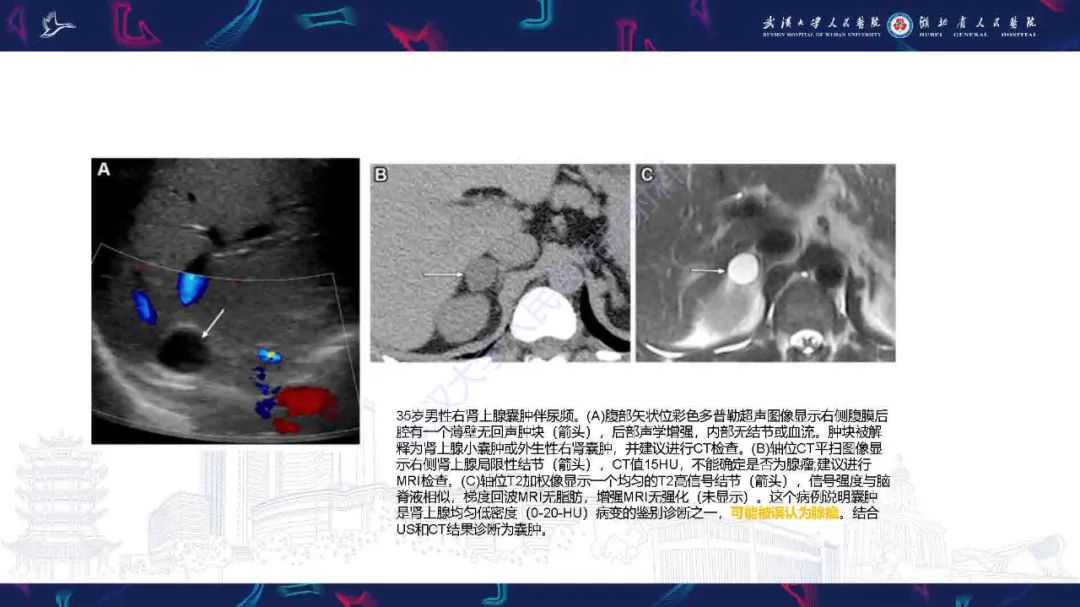 影像PPT - 【PPT】肾上腺肿瘤影像诊断-22