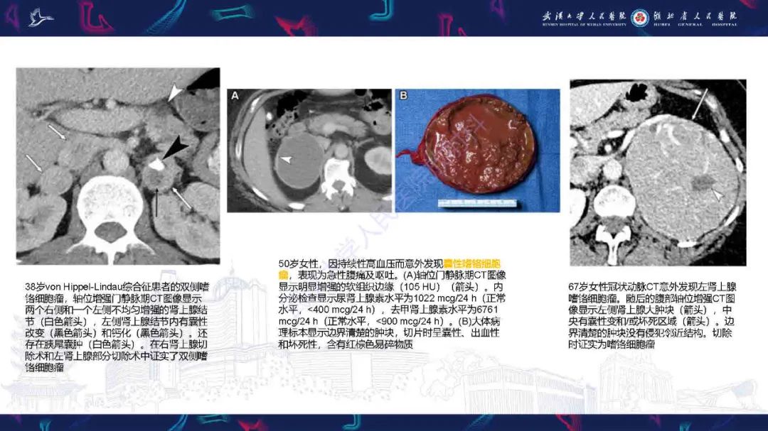 影像PPT - 【PPT】肾上腺肿瘤影像诊断-25