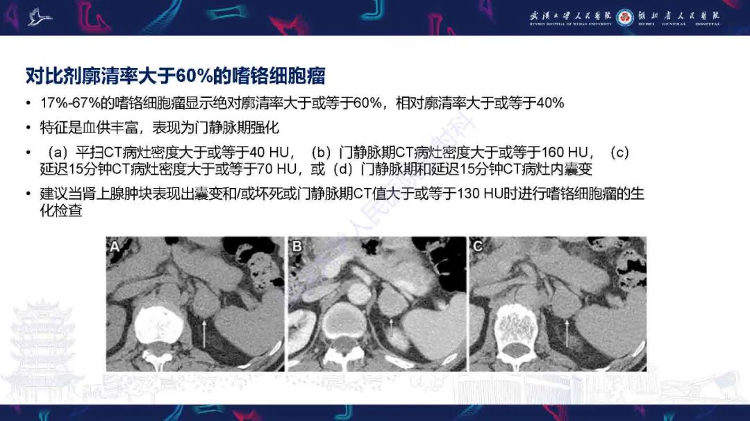 影像PPT - 【PPT】肾上腺肿瘤影像诊断-26