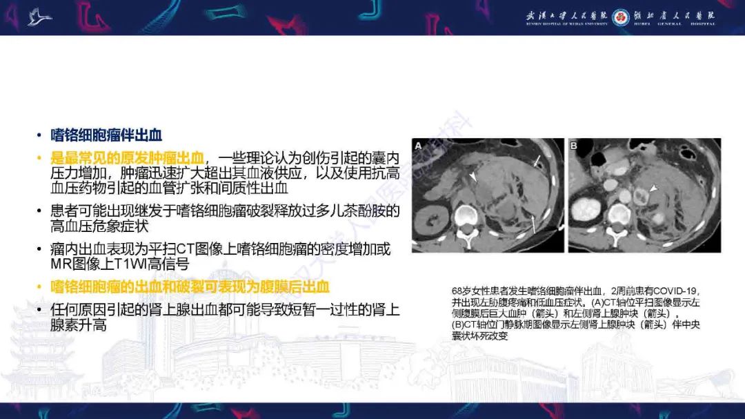 影像PPT - 【PPT】肾上腺肿瘤影像诊断-27
