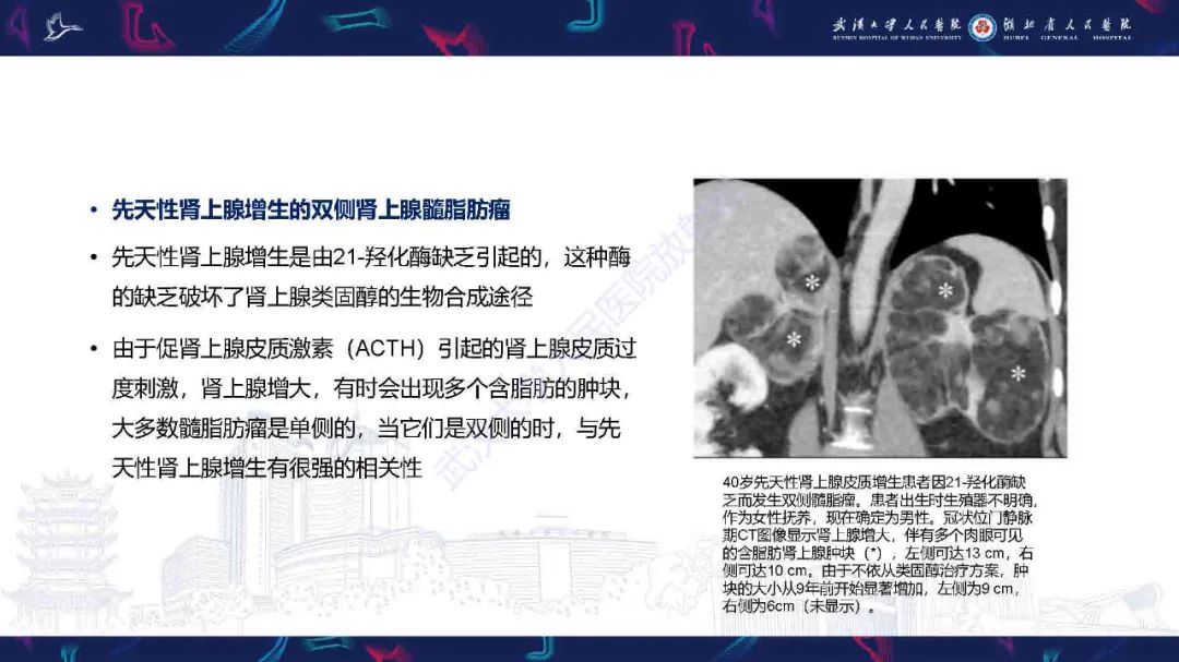 影像PPT - 【PPT】肾上腺肿瘤影像诊断-30