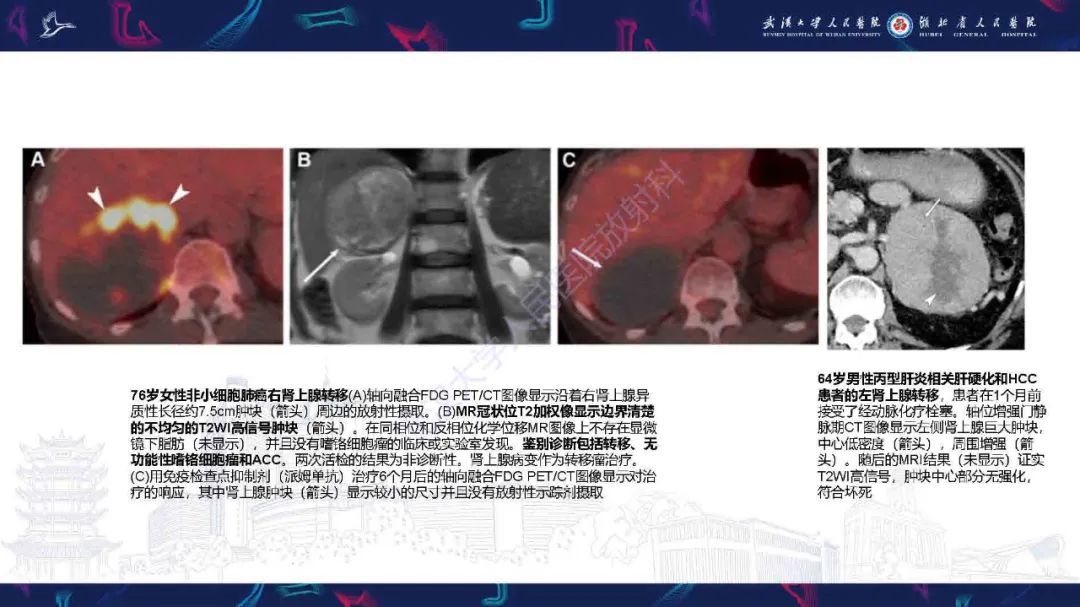 影像PPT - 【PPT】肾上腺肿瘤影像诊断-32