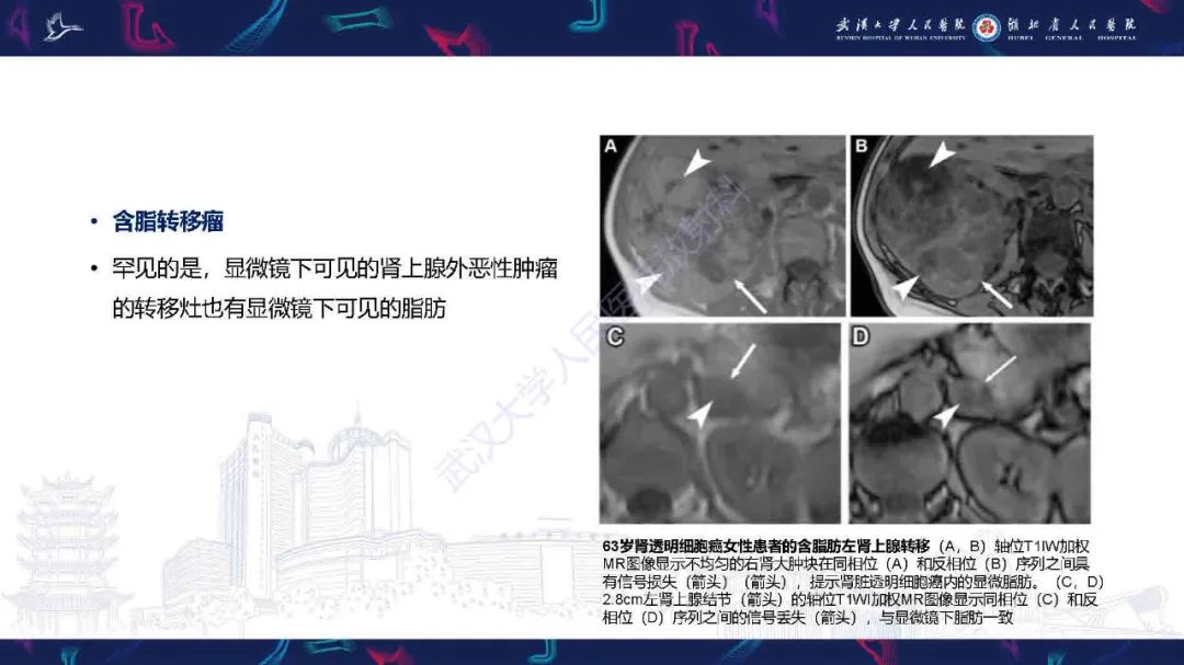 影像PPT - 【PPT】肾上腺肿瘤影像诊断-33