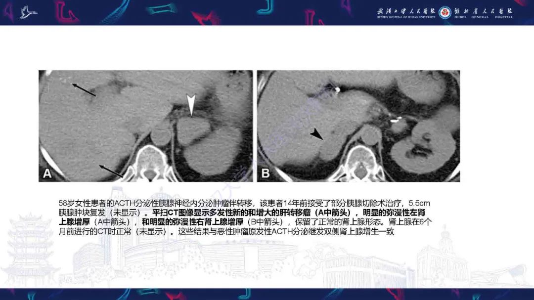 影像PPT - 【PPT】肾上腺肿瘤影像诊断-36