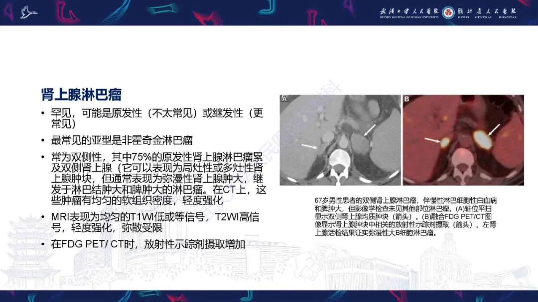 影像PPT - 【PPT】肾上腺肿瘤影像诊断-38