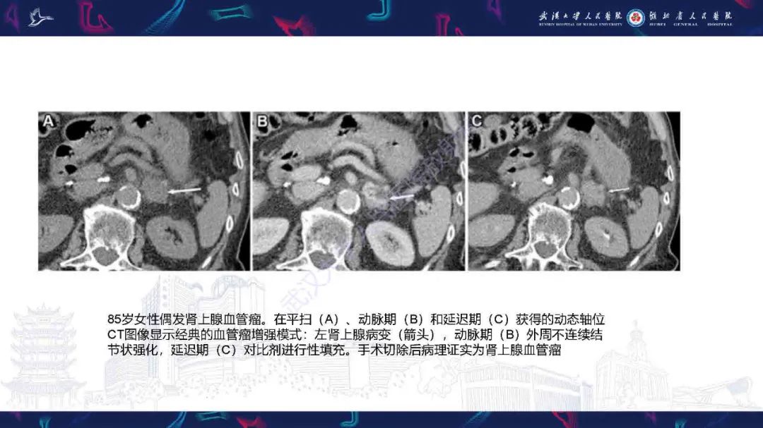 影像PPT - 【PPT】肾上腺肿瘤影像诊断-40