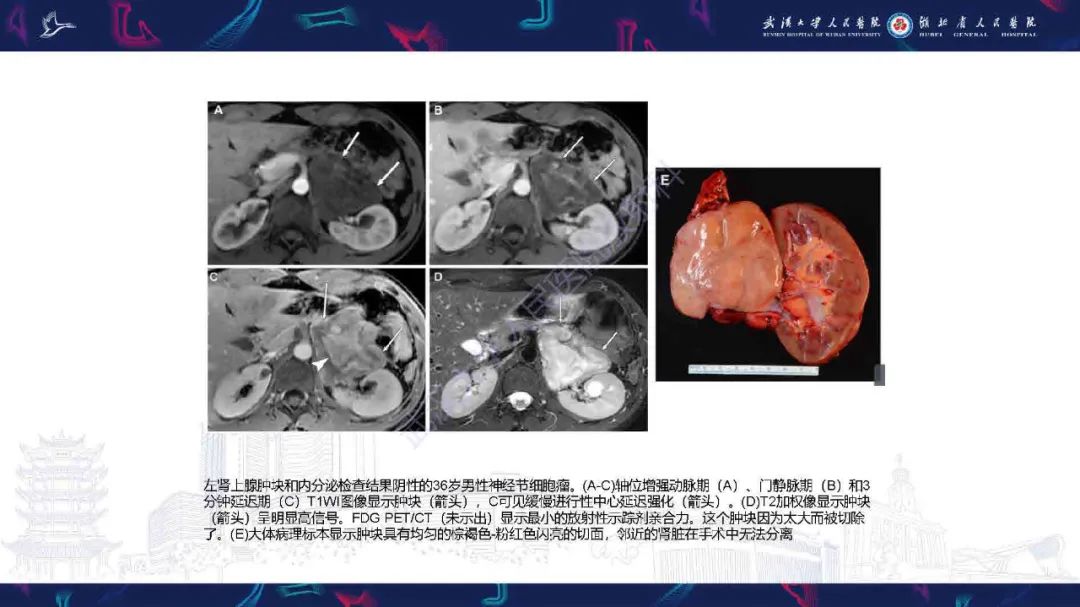 影像PPT - 【PPT】肾上腺肿瘤影像诊断-43