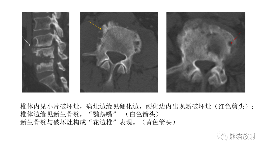 影像PPT - 【病例】布氏杆菌性脊柱炎2例CT及MR影像-21