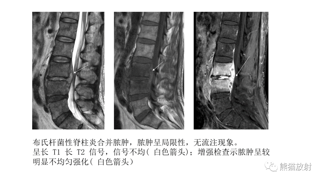 影像PPT - 【病例】布氏杆菌性脊柱炎2例CT及MR影像-23