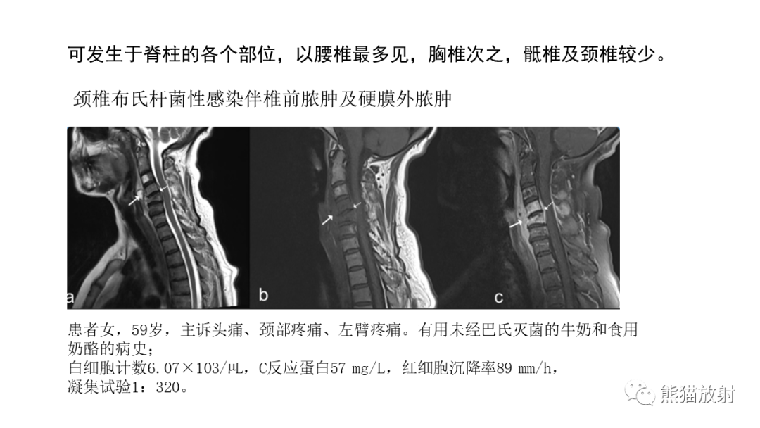 影像PPT - 【病例】布氏杆菌性脊柱炎2例CT及MR影像-25