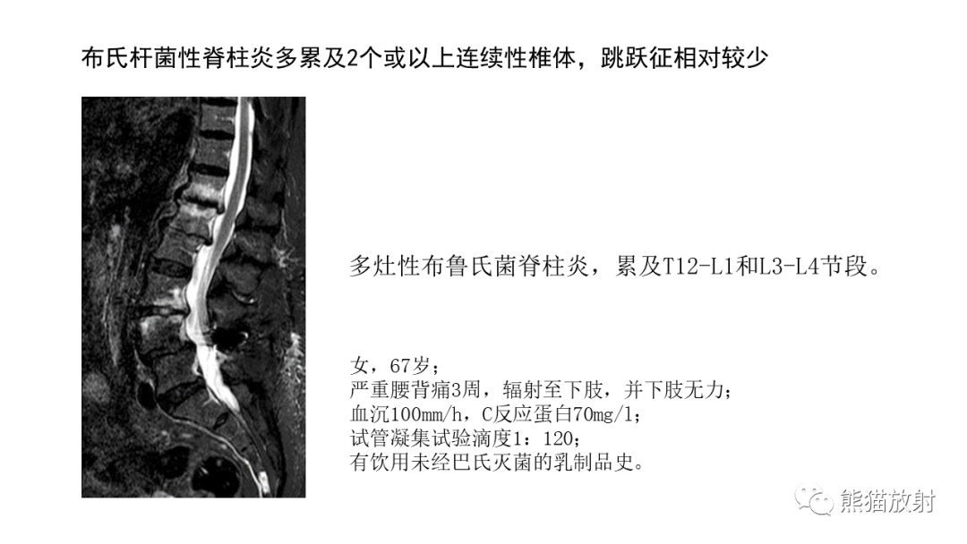 影像PPT - 【病例】布氏杆菌性脊柱炎2例CT及MR影像-26