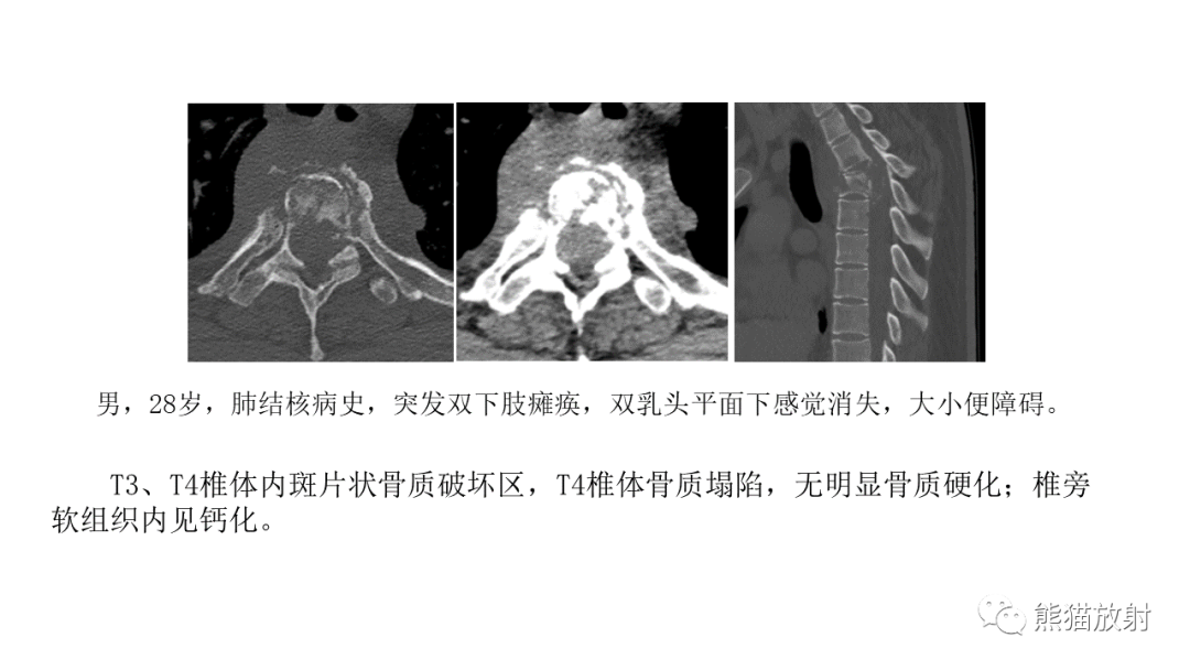 影像PPT - 【病例】布氏杆菌性脊柱炎2例CT及MR影像-28