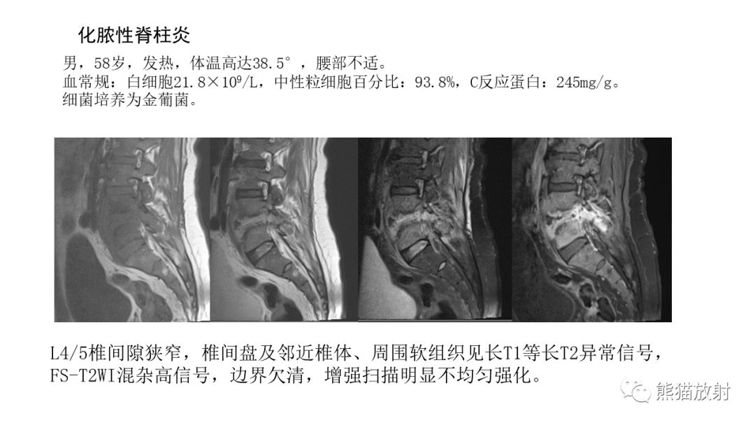 影像PPT - 【病例】布氏杆菌性脊柱炎2例CT及MR影像-31