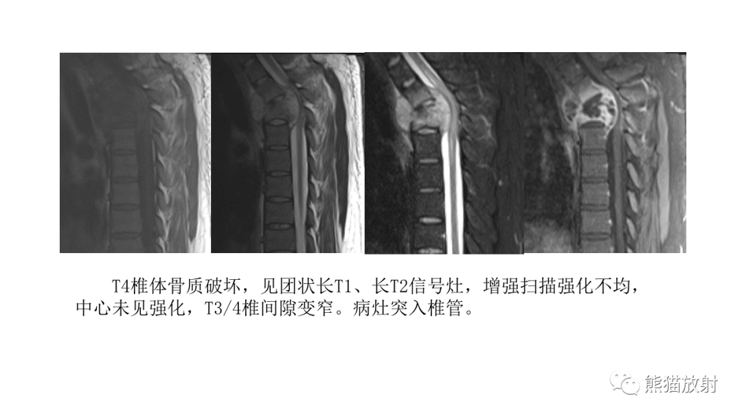 影像PPT - 【病例】布氏杆菌性脊柱炎2例CT及MR影像-29