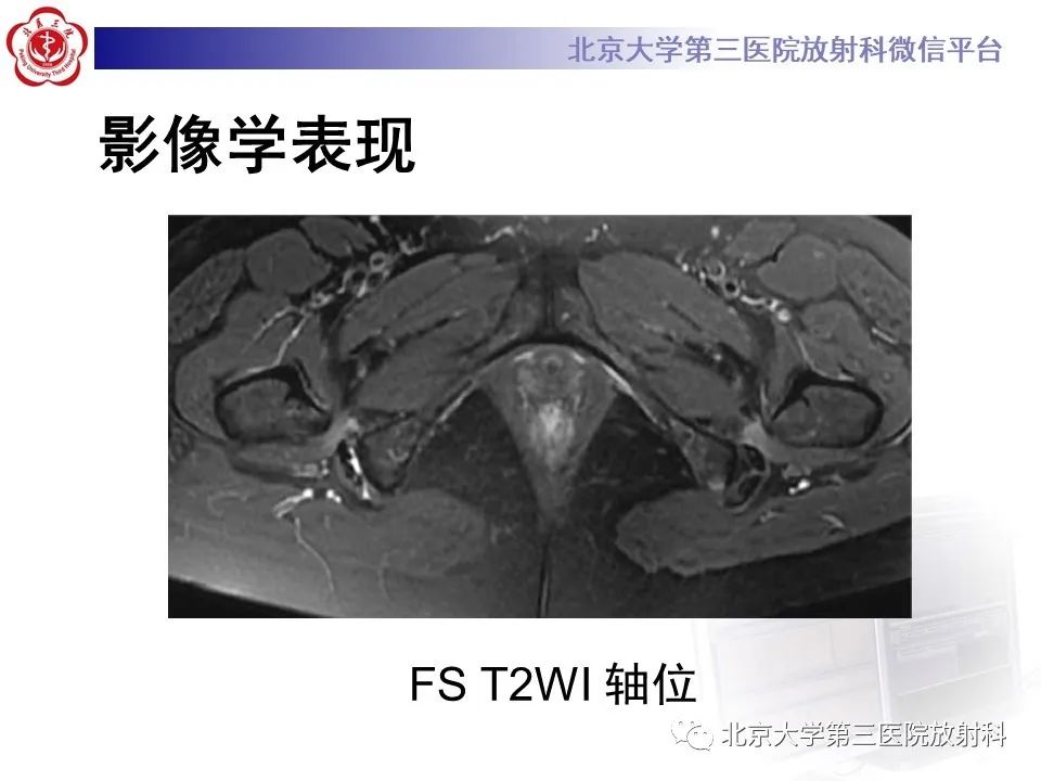 影像PPT - 【PPT】坐骨—股骨撞击综合征-3