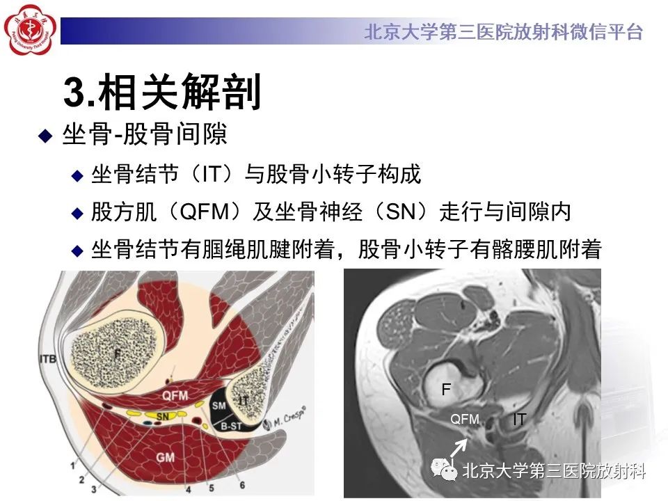 影像PPT - 【PPT】坐骨—股骨撞击综合征-8