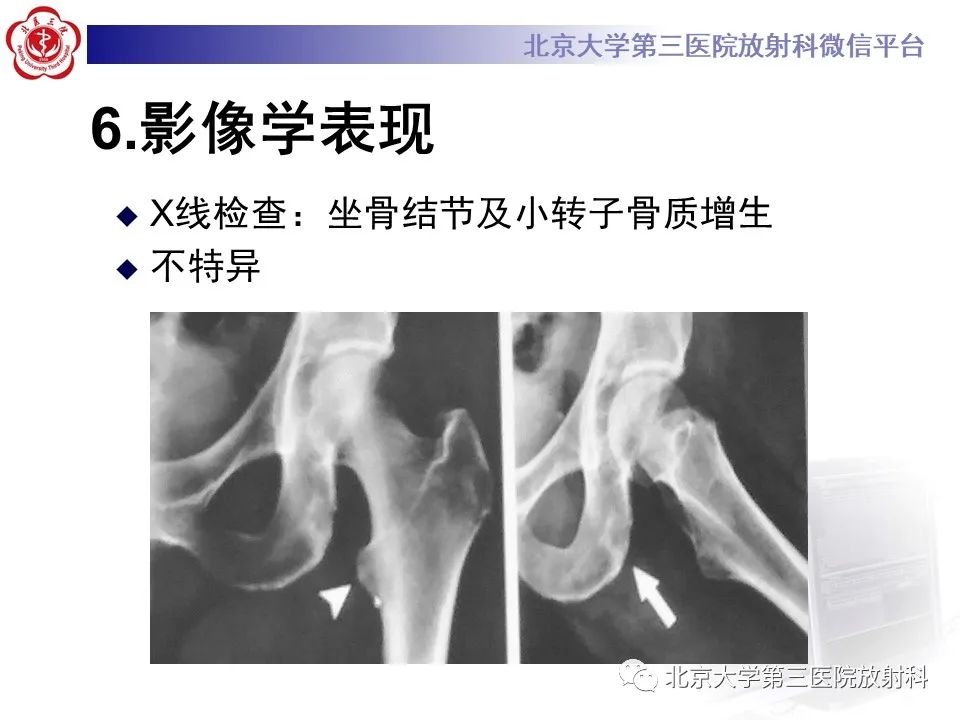 影像PPT - 【PPT】坐骨—股骨撞击综合征-12