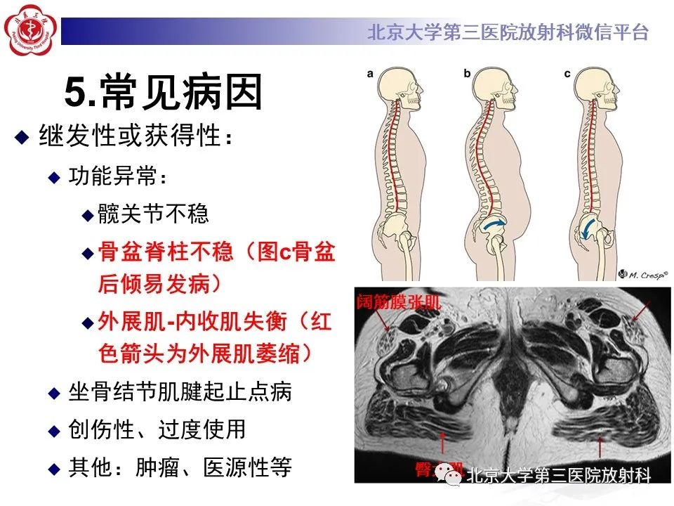 影像PPT - 【PPT】坐骨—股骨撞击综合征-11