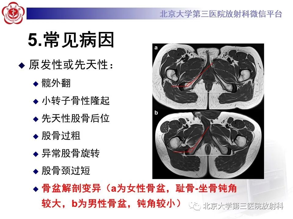 影像PPT - 【PPT】坐骨—股骨撞击综合征-10