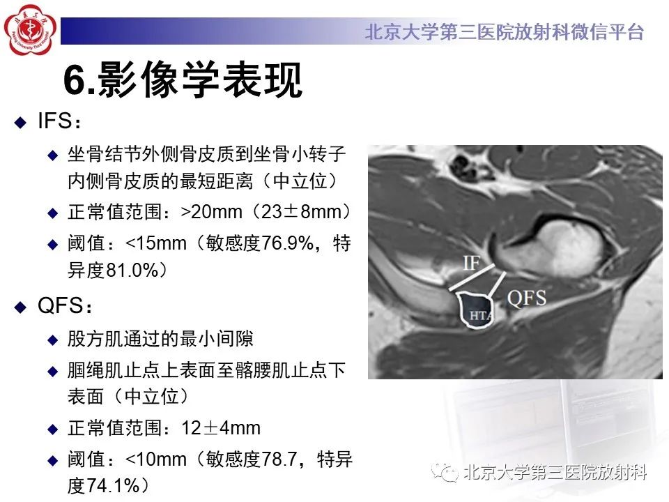 影像PPT - 【PPT】坐骨—股骨撞击综合征-14