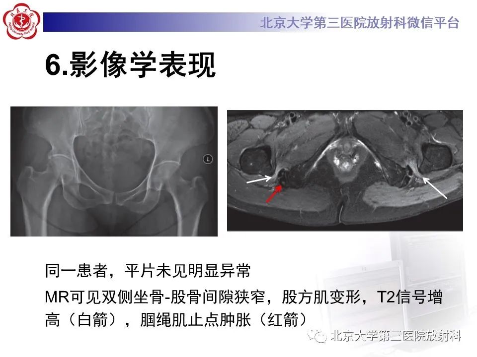 影像PPT - 【PPT】坐骨—股骨撞击综合征-15