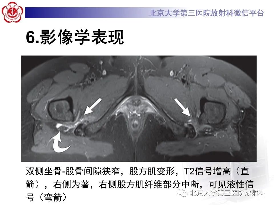 影像PPT - 【PPT】坐骨—股骨撞击综合征-16