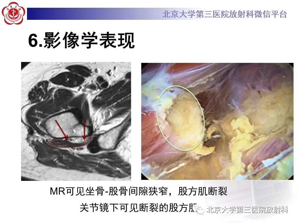影像PPT - 【PPT】坐骨—股骨撞击综合征-17