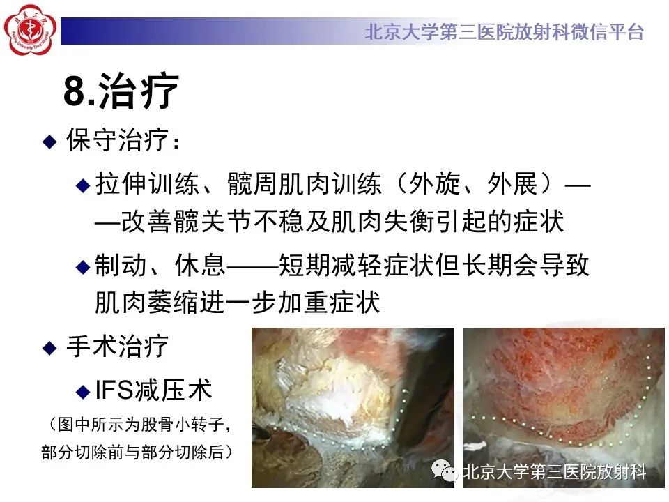 影像PPT - 【PPT】坐骨—股骨撞击综合征-19